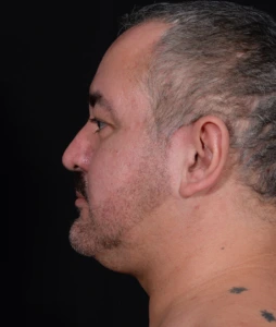 Liposuction-Case--368 | Before Face 2