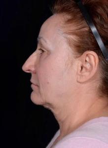 Facelift-Case--363 | Before Face 2