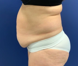 Abdominoplasty-Case--21804 | Before Body 2