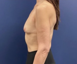 Subfascial-Breast-Augmentation-Case--26649 | Before Dr. Samir Rao 2