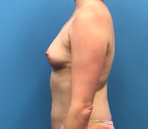Breast-Augmentation-Case--219 | Before Breast Augmentation 2
