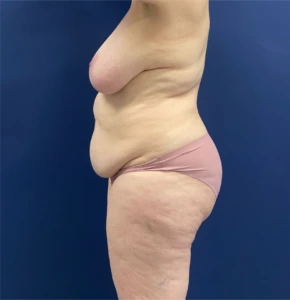 Mommy-Makeover-Case--26853 | Before Body 2