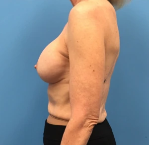 Revision-Breast-Augmentation-Case--237 | Before Revision Augmentation 2