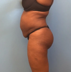 Case--246 | Before Body 2