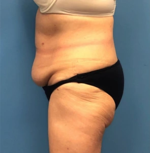 Case--251 | Before Body 2