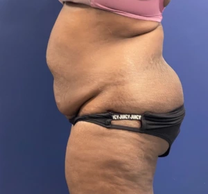 Case--257 | Before Body 2