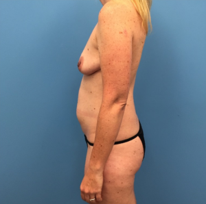 Mommy-Makeover-Case--261 | Before Mommy Makeover 2