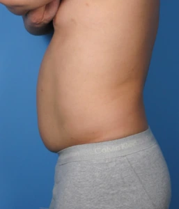 Case--389 | Before Body 2