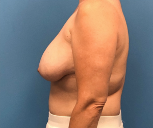 Breast-Reconstruction-Case--308 | Before Dr. Samir Rao 2