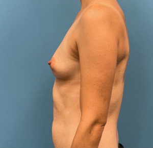 Breast-Reconstruction-Case--25209 | Before Dr. Samir Rao 2