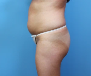 Brazilian-Butt-Lift-Case--265 | Before Body 2