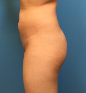 Brazilian-Butt-Lift-Case--73 | Before Brazilian Butt Lift 2