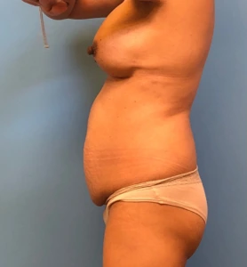 Case--11542 | Before Body 2