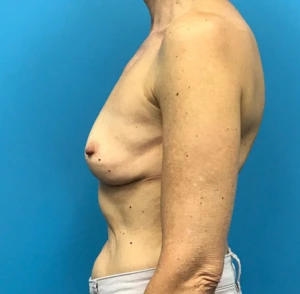 Revision-Augmentation--13287 | Before Dr. Samir Rao 2