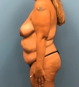 Lipoabdominoplasty-Breast-Augmentation-Case--15133 | Before Body 2