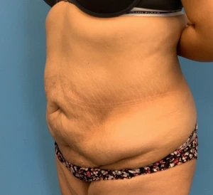 Abdominoplasty-Case--23747 | Before Body 2