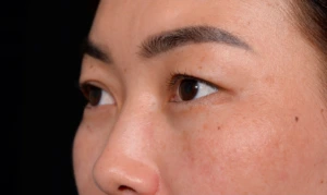 Blepharoplasty-Case--356 | Before Face 2