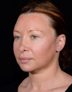 Facelift-Case--355 | Before Face 2