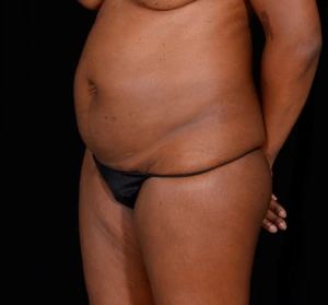 Tummy-Tuck-Case--340 | Before Body 2