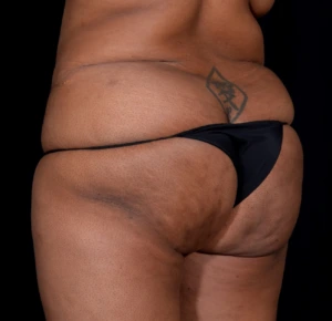 Brazilian-Butt-Lift-Case--352 | Before Body 1