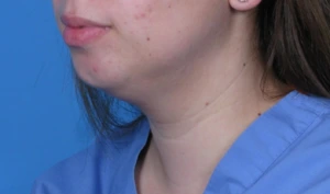 Case--293 | Before Face 2