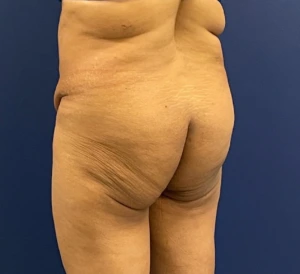 Brazilian-Butt-Lift-Case--215 | Before Body 2