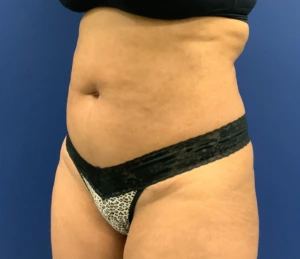 Lipoabdominoplasty-Case--21755 | Before Body 2