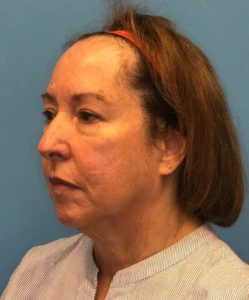 Facelift-Case--21241 | Before Face 2