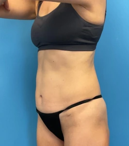 Revision-Tummy-Tuck-Case--23643 | Before Body 2