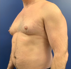 Gynecomastia-Case--20376 | Before Gynecomastia / Male Breast Reduction 2
