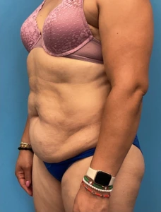 Tummy-Tuck-Case--25988 | Before Body 2