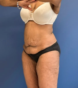 Tummy-Tuck-Case--28714 | Before Body 2