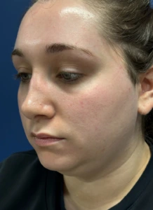 Submental-Liposuction-Case--29107 | Before Face 1