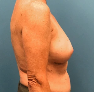 Case--13861 | Before Breast Reconstruction 2