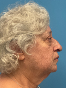 Rhinoplasty-Case--25467 | Before Rhinoplasty 2