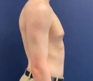 Gynecomastia-Case--214 | Before Gynecomastia / Male Breast Reduction 2