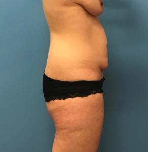 Abdominoplasty-Flank-Liposuction-Case--244 | Before Body 2