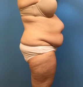 Case--249 | Before Body 2