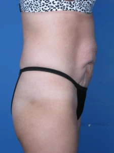 Tummy-Tuck-Case--250 | Before Body 2
