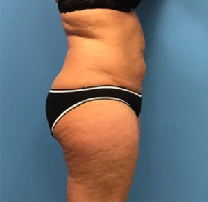 Liposuction-Case--72-1 | Before Dr. Samir Rao 2