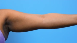 Case--279 | Before Body 2