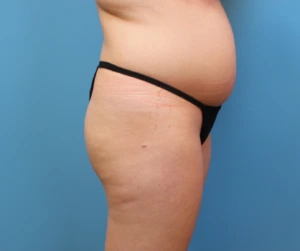 Brazilian-Butt-Lift-Case--266 | Before Body 2