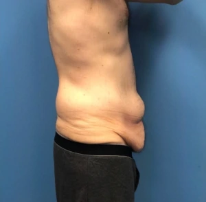 Body-Lift-Case--273 | Before Body 2