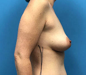 Case--96 | Before Breast Augmentation 2