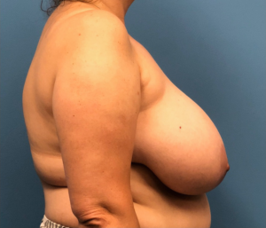 Breast-Reduction-Case--13597 | Before Breast Reduction 2