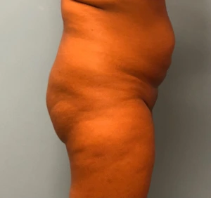 Brazilian-Butt-Lift-Case--13244 | Before Body 2