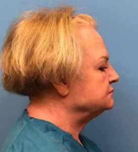 Facelift-Case--14460 | Before Face 2