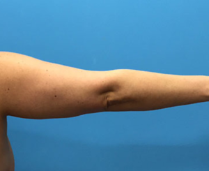 Brachioplasty-Case--78 | Before Arm Lift 2