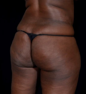 Brazilian-Butt-Lift-Case--353 | Before Dr. Arjun Kanuri 2