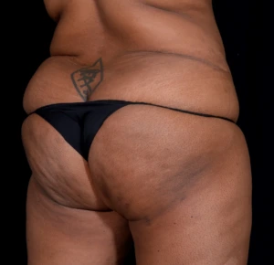 Brazilian-Butt-Lift-Case--352 | Before Body 2